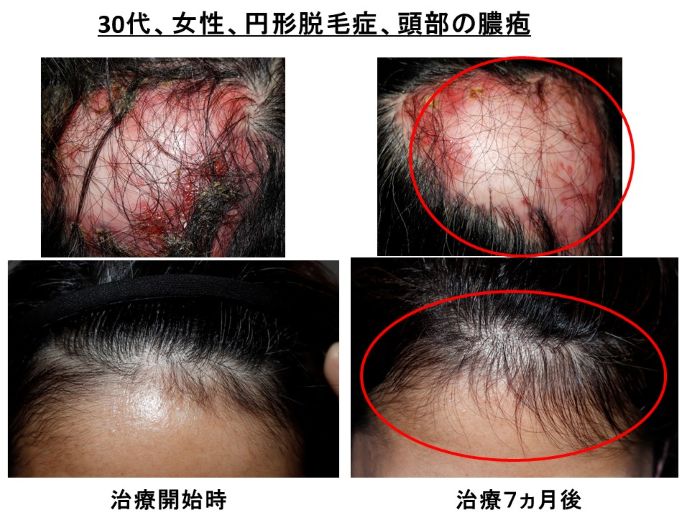円形脱毛症　病院